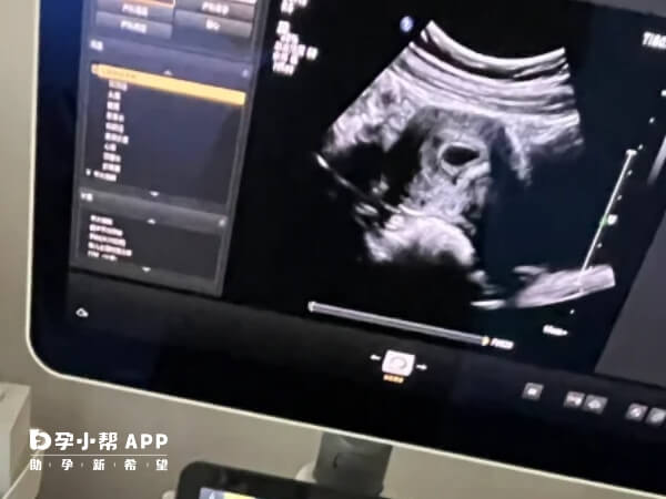 促排卵治疗并不会直接导致空囊的情况