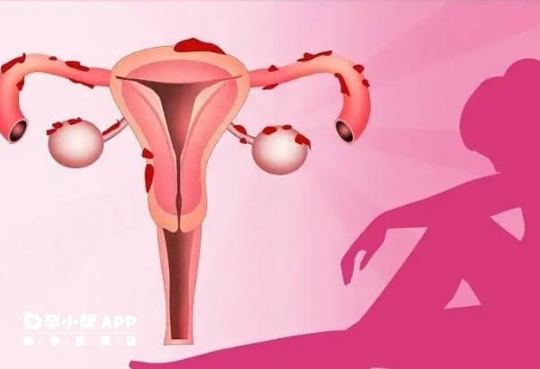 子宫内膜异位症是一种常见的妇科疾病