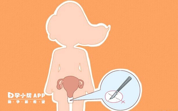始基子宫对女性有或多或少的影响
