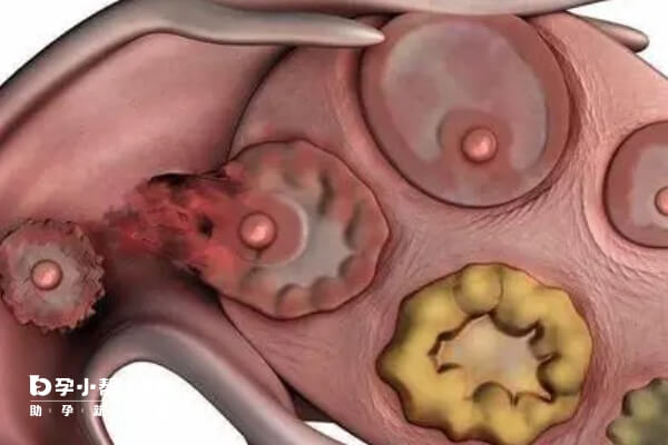 卵巢早衰影响女性健康