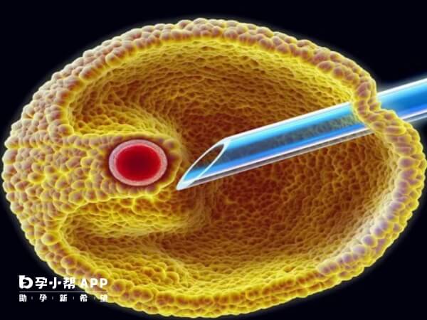 取卵针穿刺卵巢可能会误伤卵巢周围血管