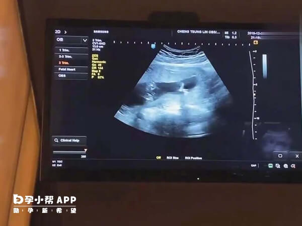 用克罗米芬促排有生双胎的可能性