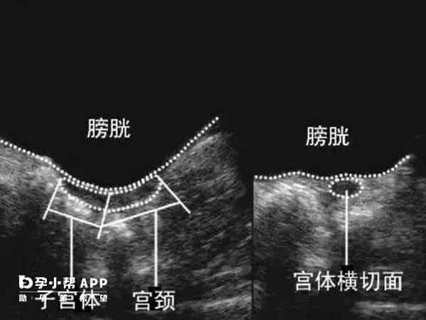 幼稚子宫就是子宫发育异常情况之一