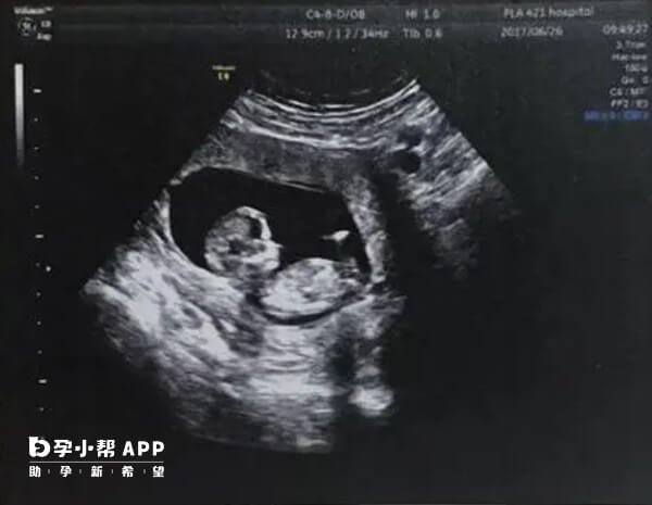 双胞胎小排畸重点检查脑部