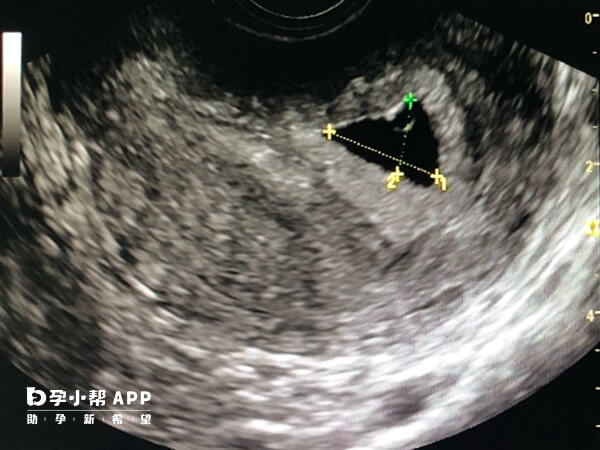 医保就是指的社会医疗保险