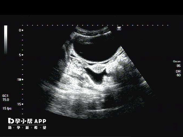 幼稚子宫就是石女的一种