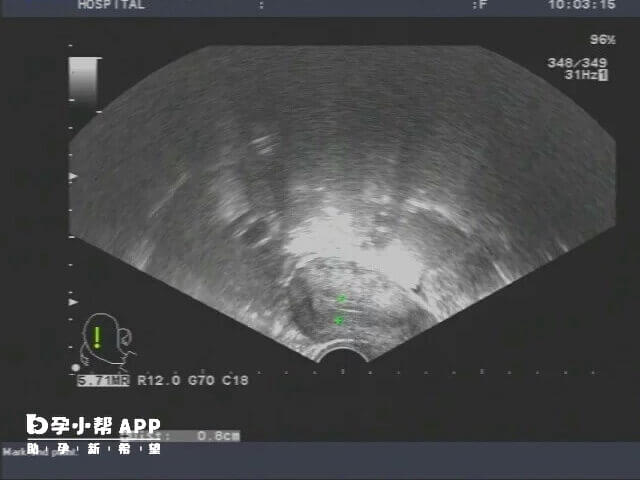 子宫内膜三线征完整提示内膜容受性好