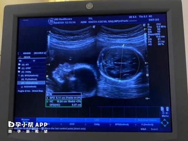 胎儿系统超声检查即大排畸