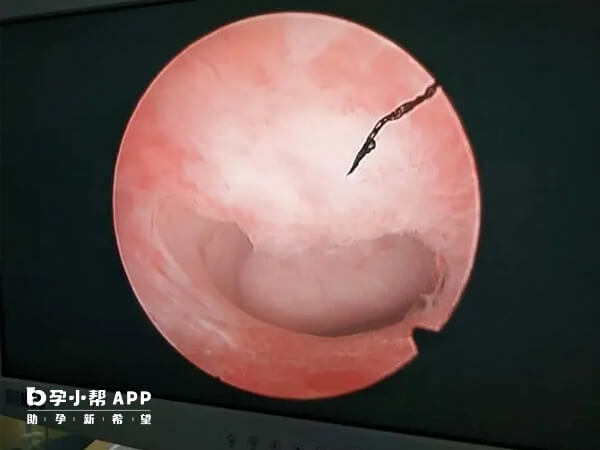 试管移植前子宫内膜理想厚度为8-14mm