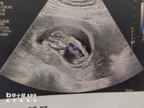 nt检查主要观察胎儿颈部透明带的厚度