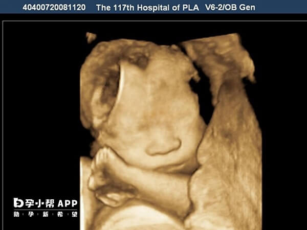 孕中期大排畸超声可替代nt检查