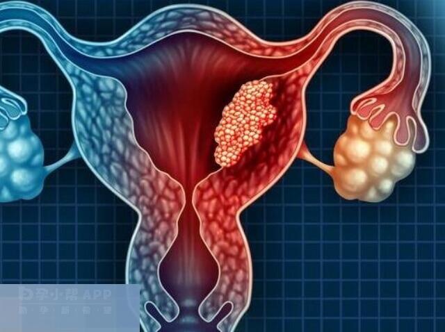 卵巢囊肿对女性生育功能有影响