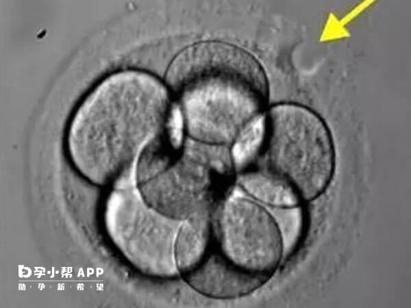 透明带异常可能导致囊胚孵化困难