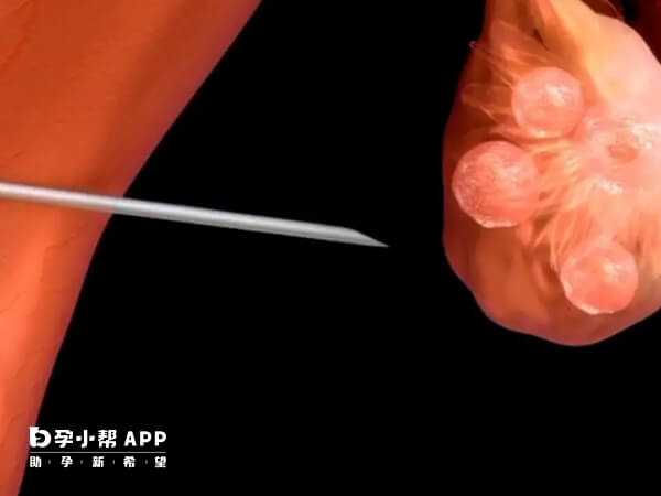 取卵后轻微血管损伤可局部压迫止血