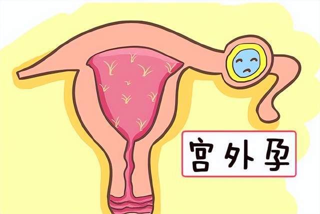 宫外孕